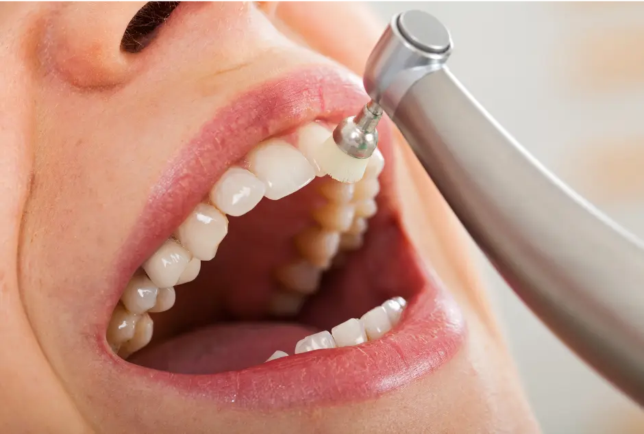 Cleanings at Valley Dental Turlock