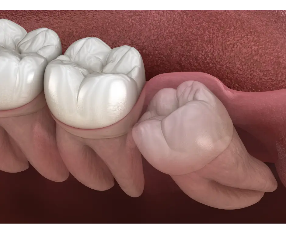 Dentist preparing for a gentle tooth extraction at Valley Dental Turlock