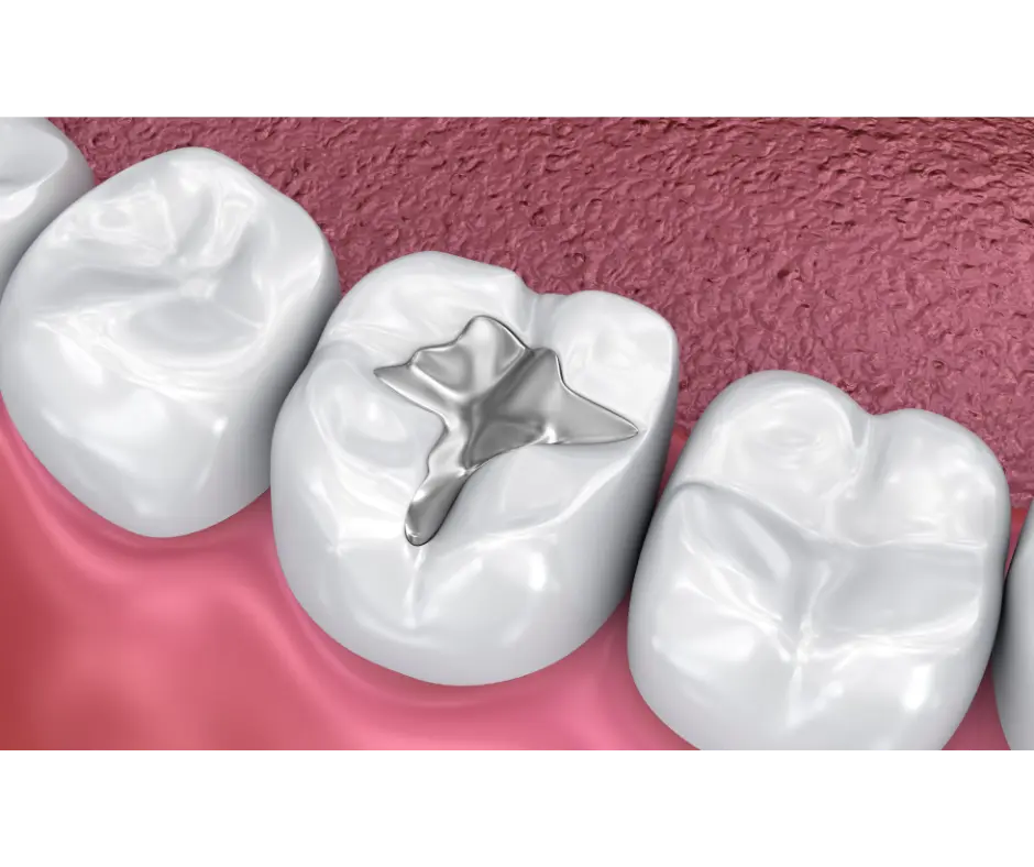 Fillings at Valley Dental Turlock