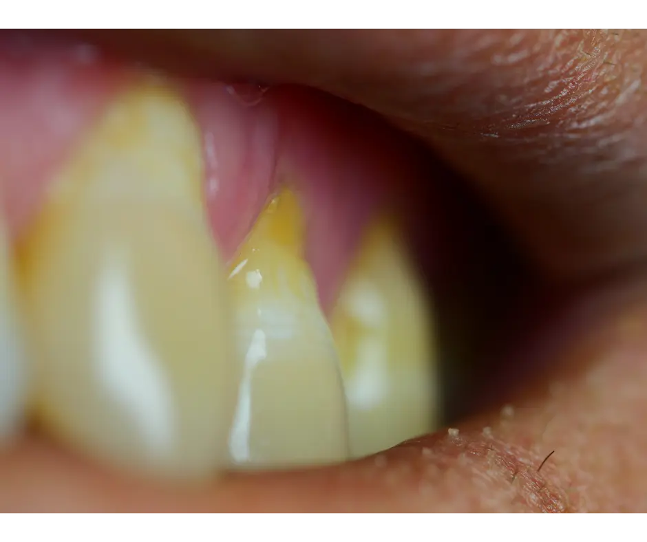 Gum Disease at Valley Dental Turlock