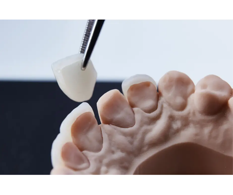 Veneers