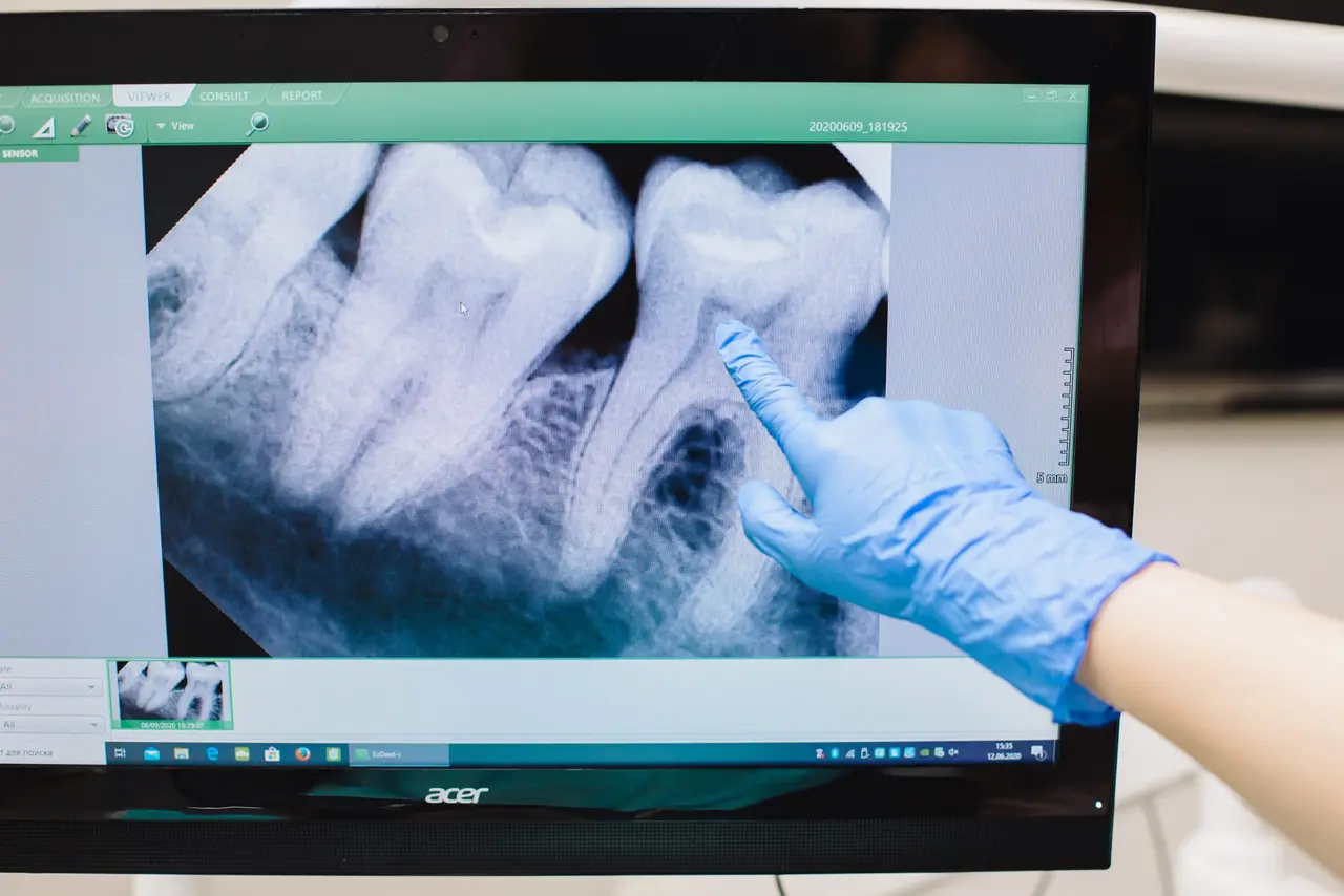 How Often Do You Need Dental X-Rays?